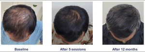 Hair Loss Patients Want Results, Not Guesswork: New Scientific Platform Focuses On Consistency & Standardised Outcomes In Hair Restoration