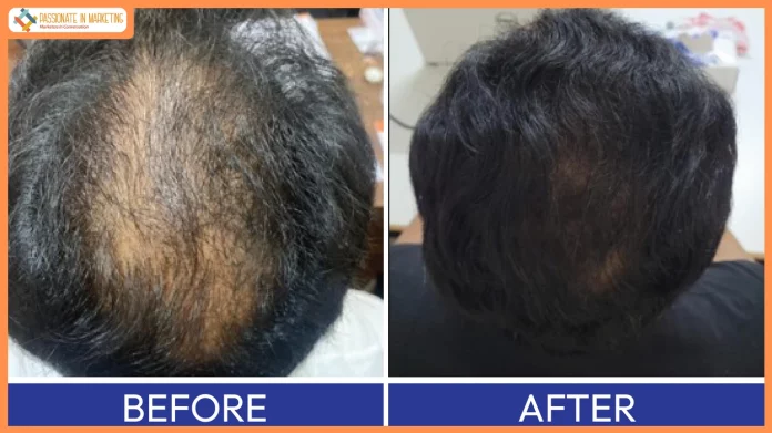 From Hyderabad to a Global Hair Regeneration Platform: QR678® Secures New Indian Patent for Hair Regeneration Kit